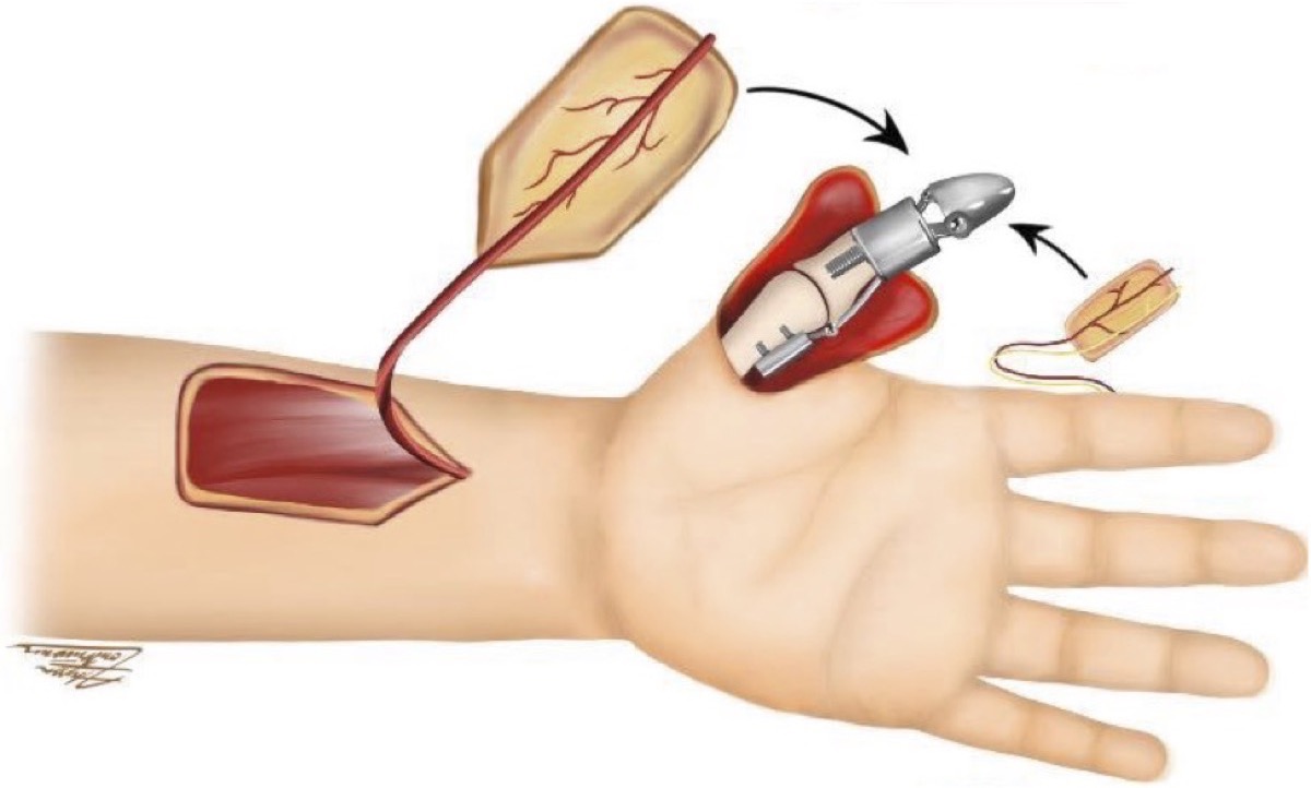Biosynthetic thumb prosthesis illustration